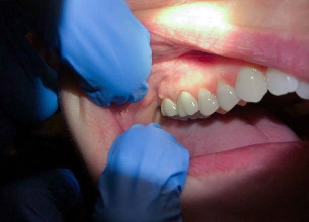 Best Knocked-Out Tooth (Avulsed Tooth) Treatment in Spicer, MN